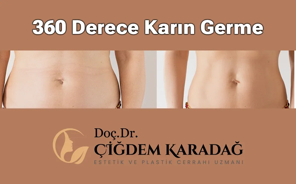 360 Derece Karın Germe Nedir? Hangi Hastalara Uygundur? - Doç. Dr. Çiğdem Karadağ 360 Derece Karın Germe Ameliyatı