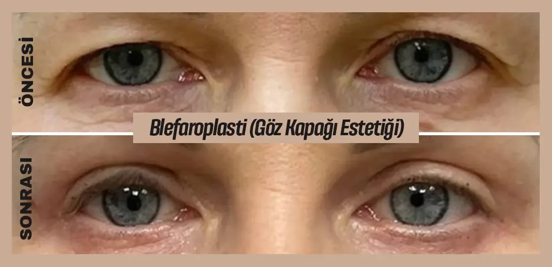 Blefaroplasti (Göz Kapağı Estetiği) Öncesi ve Sonrası