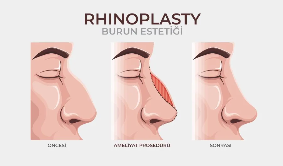 Burun Estetiği (Rinoplasti) Hakkında Her Şey - Doç. Dr. Çiğdem Karadağ Burun Estetiği