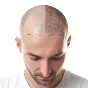 Erkek Tipi Saç Dökülmesi Nedir? Neden Olur?