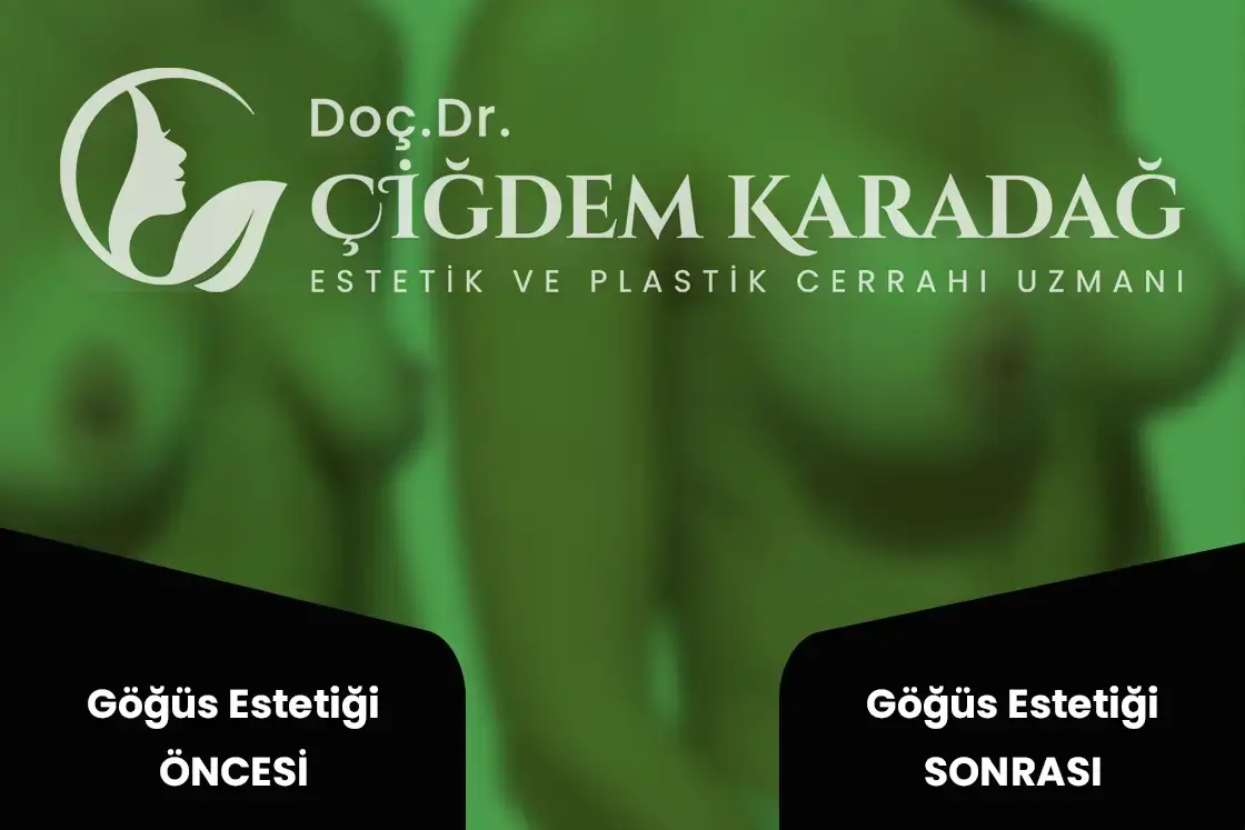 Göğüs (Meme) Estetiği Öncesi, Sonrası