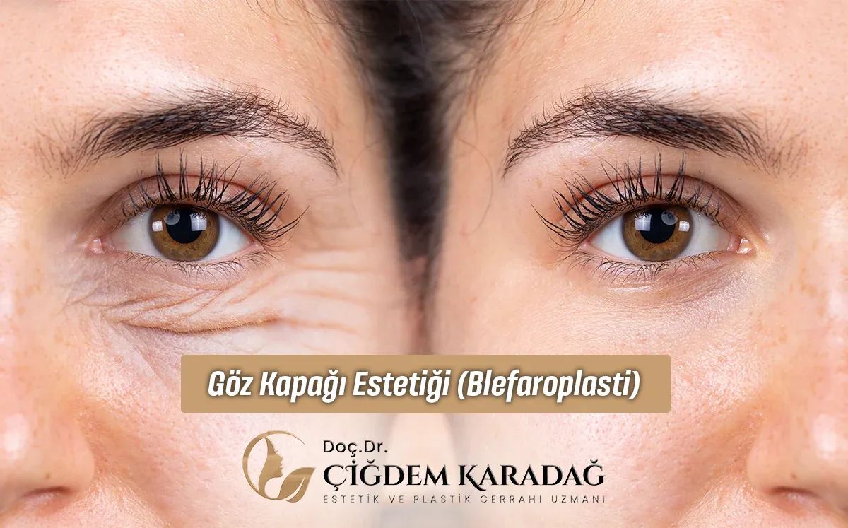 Göz Kapağı Estetiği (Blefaroplasti) - Doç. Dr. Çiğdem Karadağ Göz Kapağı Estetiği (Blefaroplasti)