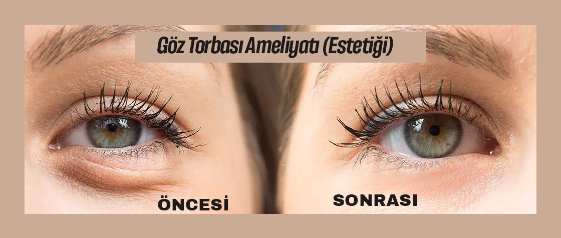Göz Torbası Estetiği (Ameliyatı)