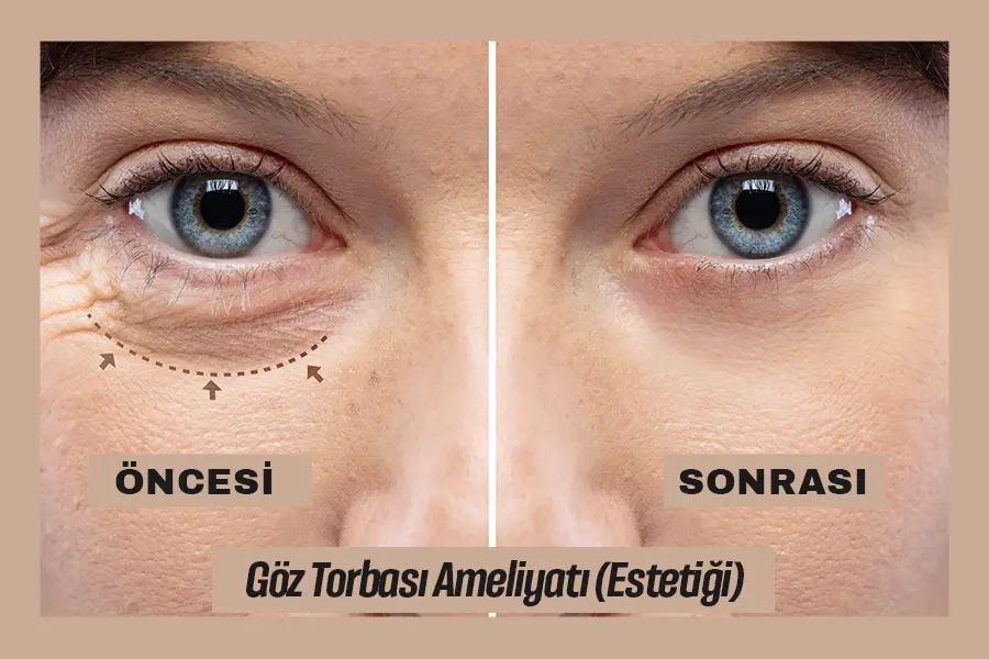 Göz Torbası Estetiği (Ameliyatı)