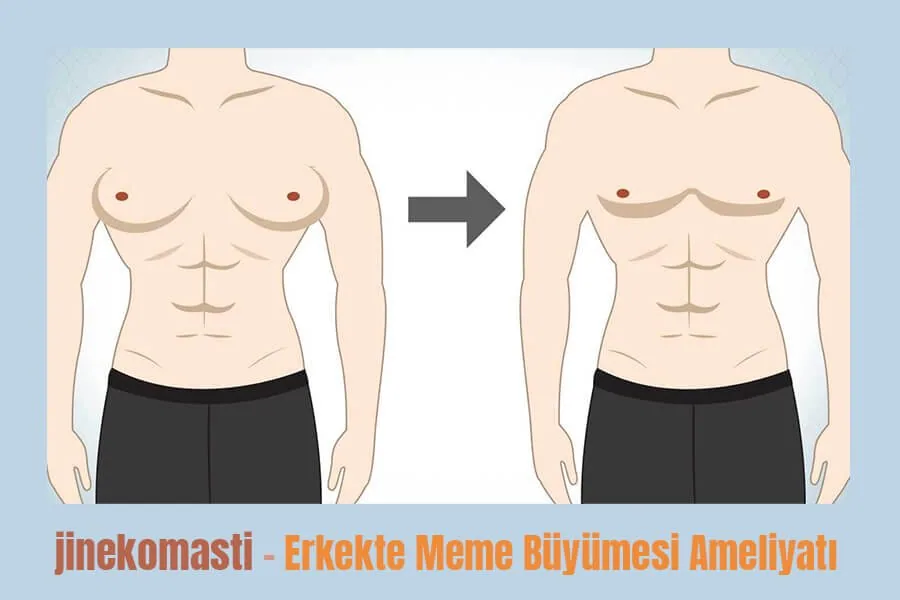 Jinekomasti - Erkekte Meme Büyümesi Hastalığı