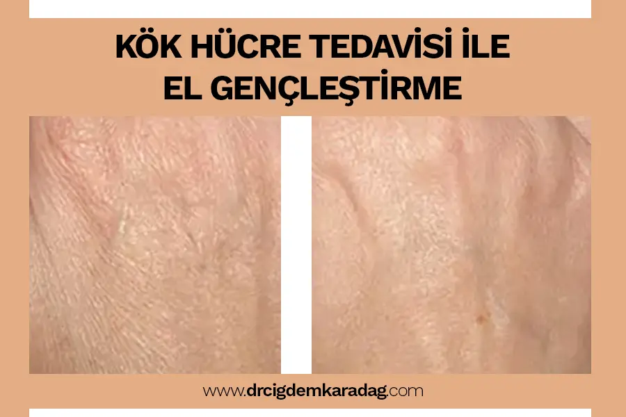 Kök Hücre Tedavisi: Cilt Gençleştirme - Doç. Dr. Çiğdem Karadağ Kök Hücre ile El Gençleştirme Tedavisi