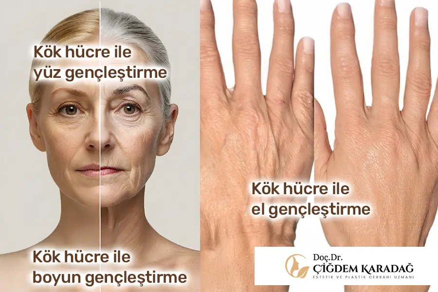 Yağdan Türetilmiş Kök Hücre İle Cilt Gençleştirme - Doç. Dr. Çiğdem Karadağ Kök hücre tedavisi ile el, yüz, boyun gençleştirme Estetiği