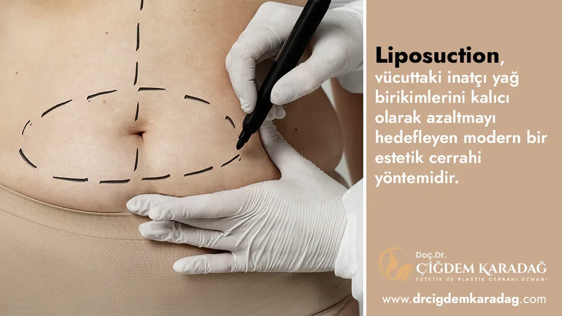 Liposuction Hangi Bölgelere Uygulanır ve Nasıl Yapılır? - Doç. Dr. Çiğdem Karadağ Liposuction Hangi Bölgelere Uygulanır ve Nasıl Yapılır?