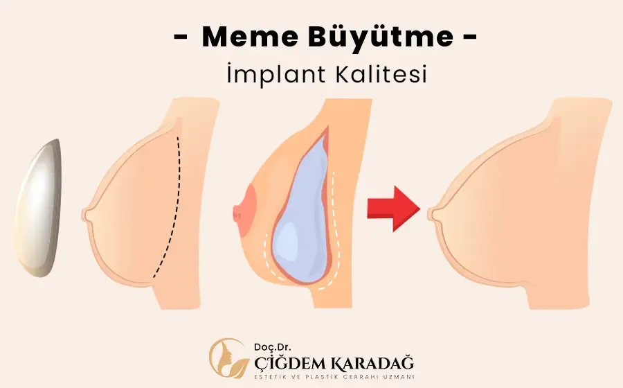 Meme büyütme – İmplantın Kalitesi Neden Bu Kadar Önemli? - Doç. Dr. Çiğdem Karadağ Meme Büyütmede İmplant Kalitesinin Önemi