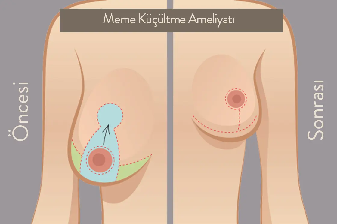 Meme Küçültme: İyileşme Zaman Çizelgesi - Doç. Dr. Çiğdem Karadağ Meme Küçültme Öncesi - Sonrası