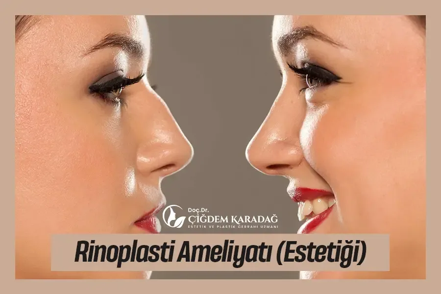 Rinoplasti (Burun) Ameliyatı - Estetiği