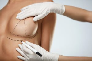 breast surgery