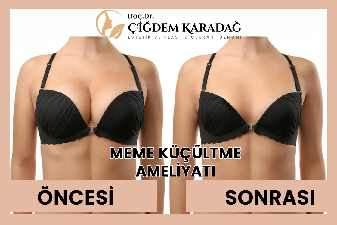 Meme Küçültme Ameliyatı