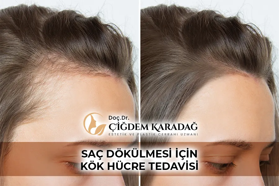 Saç Dökülmesi İçin Kök Hücre Tedavisi