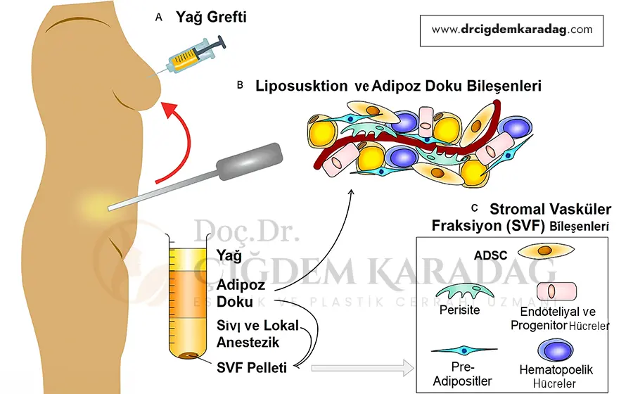 Yağdan Alınan Kök Hücre ile Estetik