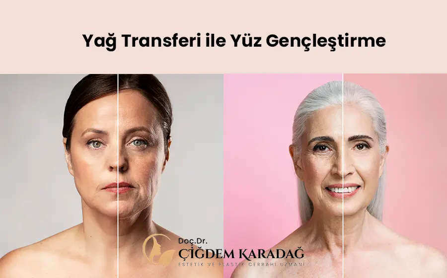 Yüze Yağ Transferi | Daha Genç Yüz Görünümüne Kavuşmak - Doç. Dr. Çiğdem Karadağ Yüze Yağ Transferi ile Yüz Gençleştirme İşlemi