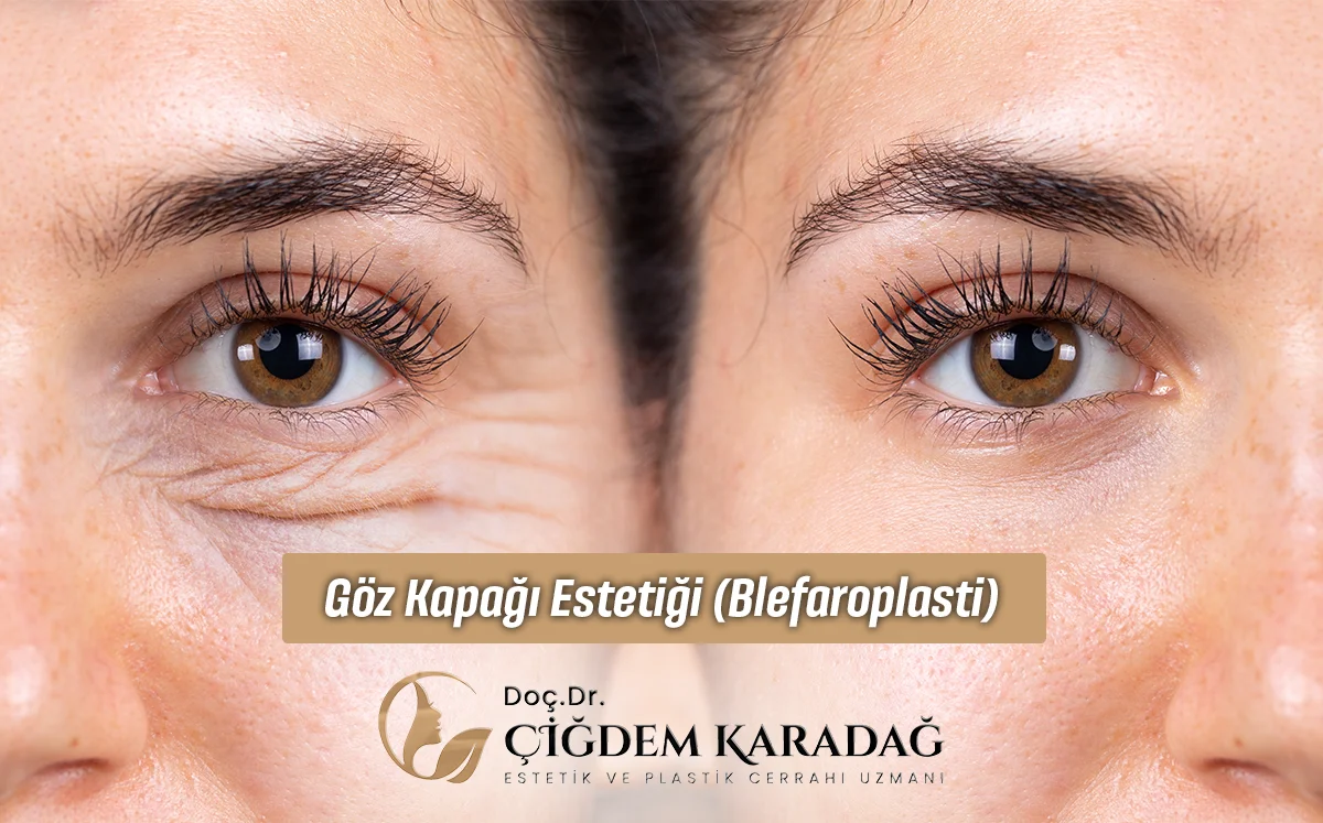 Göz Kapağı Estetiği (Blefaroplasti)